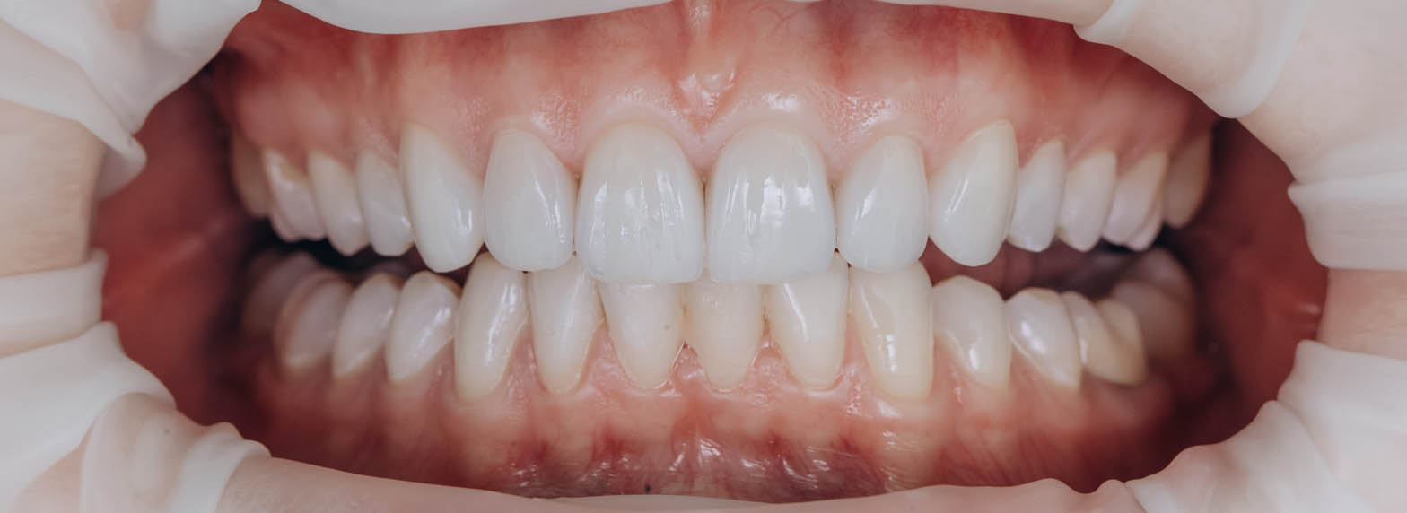 Ceramic Crowns