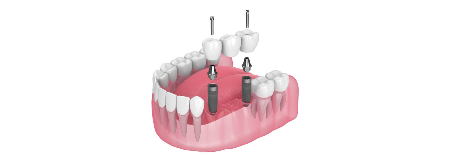 Dental Bridges