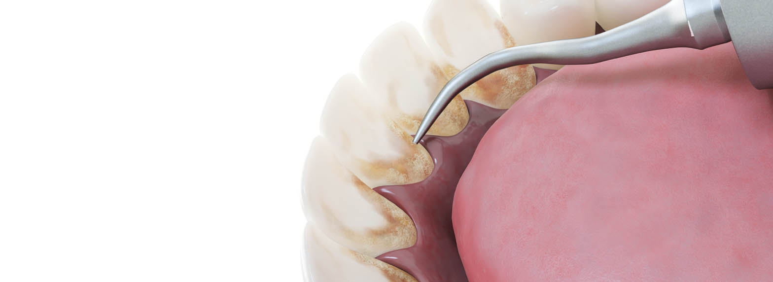 Dental Cleanings
