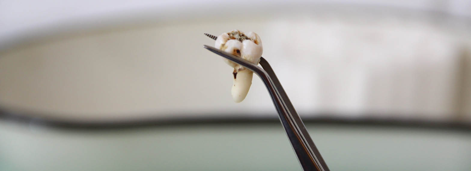 Extractions