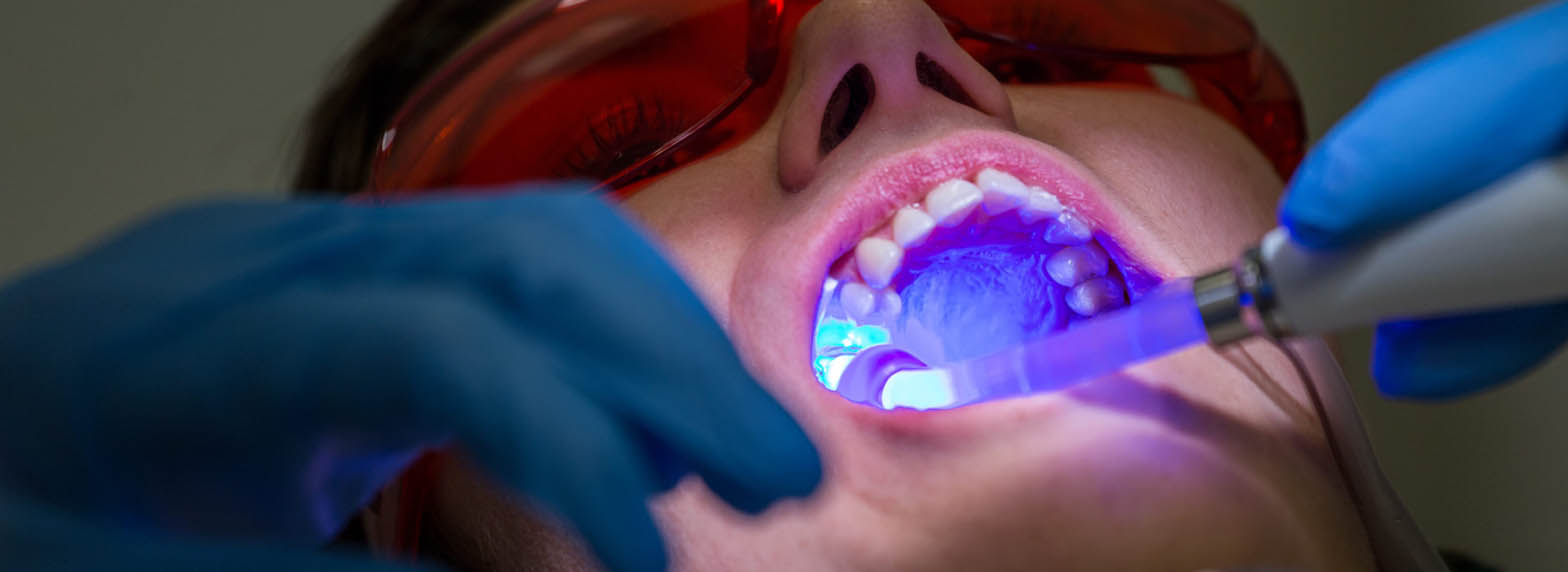 Dental Fillings