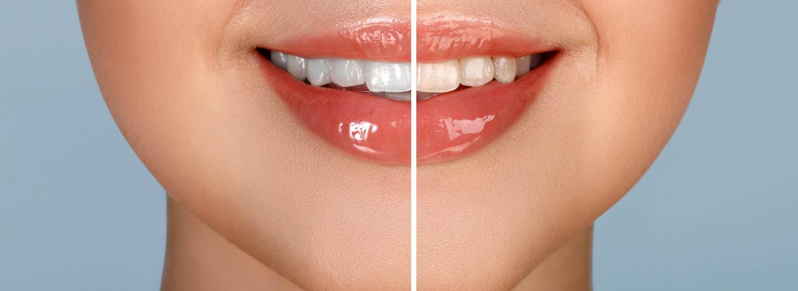 Teeth Whitening