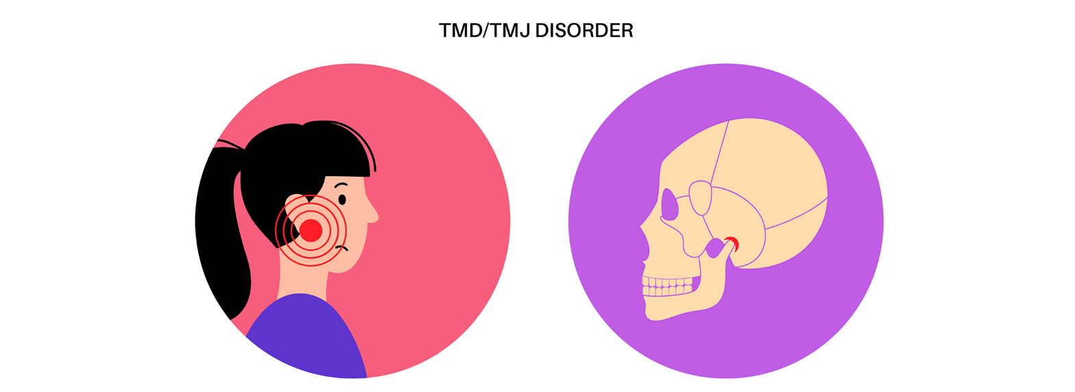 TMJ Disorders