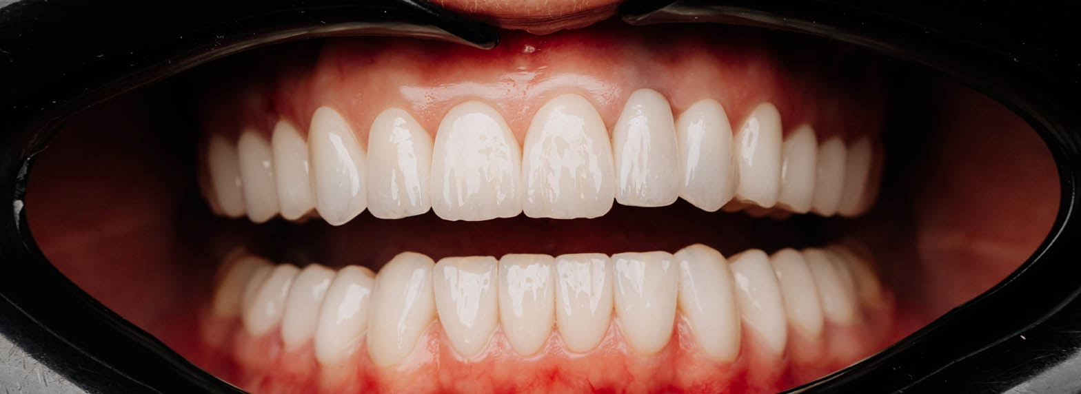 Veneers